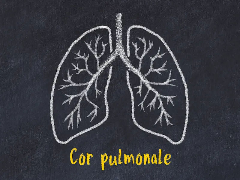 Cor Pulmonale Disease: Causes, Signs, and Diagnosis